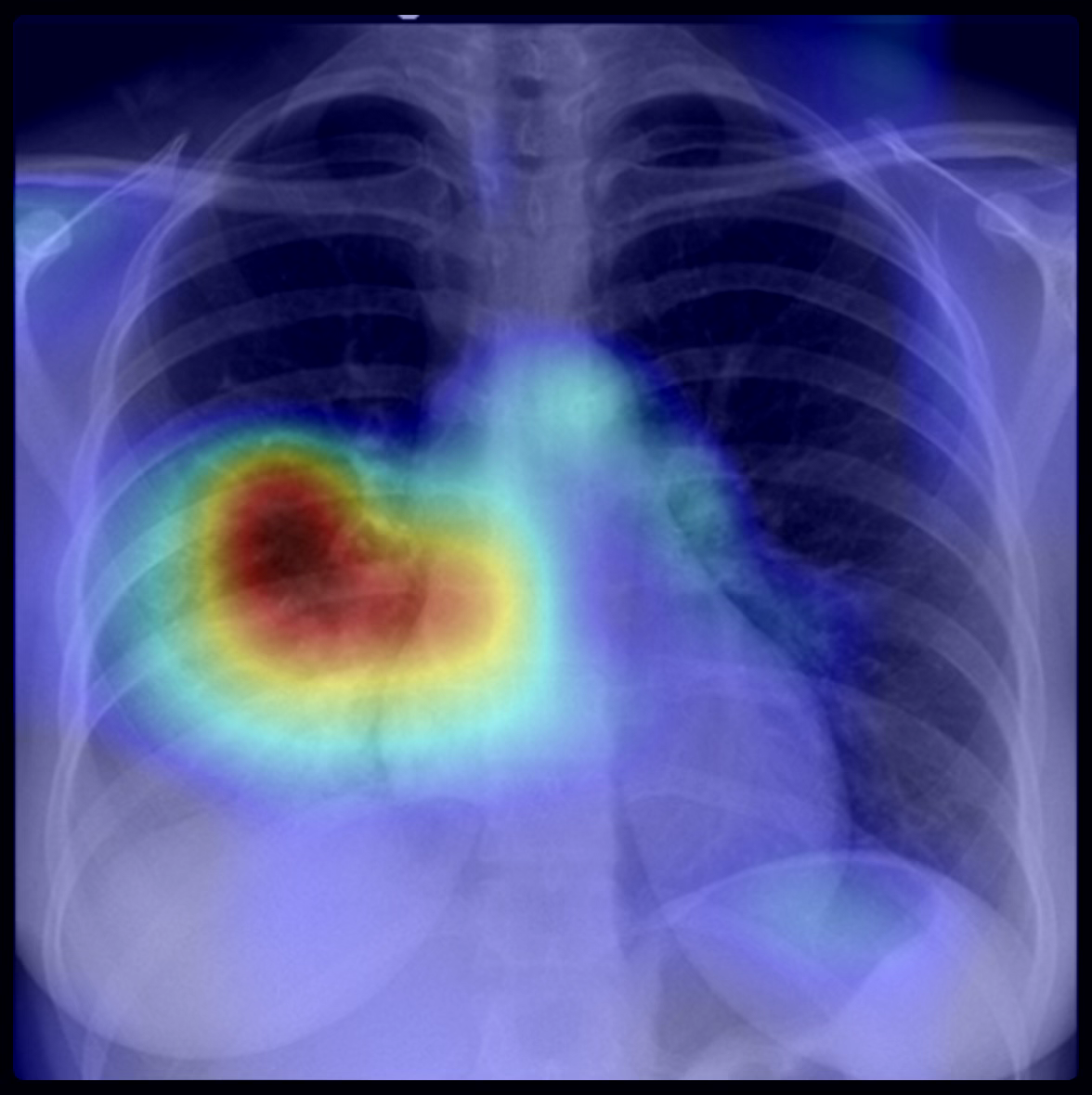 Alt text: Lenek LIRA AI heatmap on chest X-ray