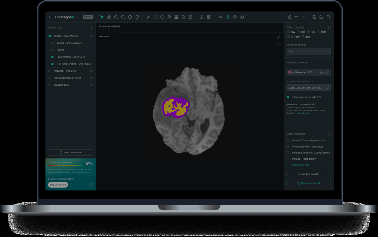 The VoxelBox viewer showing an MRI slice with AI-generated tumour segmentation